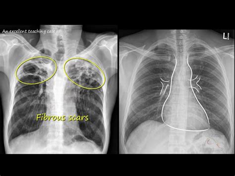 apicolordotic view treatment|Chest tuberculosis: Radiological review and imaging .